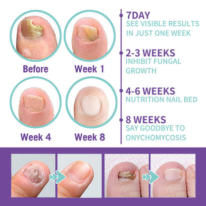 JaySuing Nail Fungus Spray – Natural Anti-Fungal Treatment for Nails