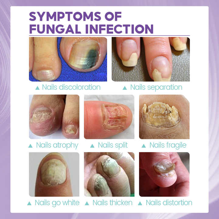 JaySuing Nail Fungus Spray – Natural Anti-Fungal Treatment for Nails