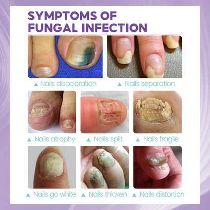 JaySuing Nail Fungus Spray – Natural Anti-Fungal Treatment for Nails